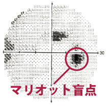 Humphrey視野計による緑内障視野障害の進行 初期