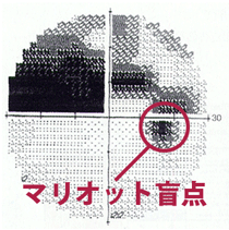 Humphrey視野計による緑内障視野障害の進行 中期