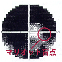 Humphrey視野計による緑内障視野障害の進行 後期