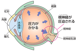 緑内障　図解